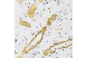 Immunohistochemistry of paraffin-embedded human liver cancer using KIF1B Antibody. (KIF1B 抗体  (AA 1501-1770))