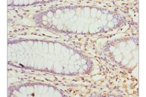 Immunohistochemistry of paraffin-embedded human colon cancer using ABIN7162928 at dilution of 1:100