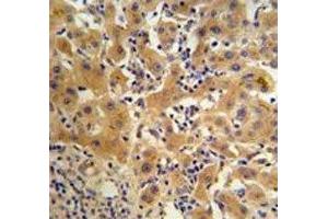 Ceruloplasmin antibody IHC analysis in formalin fixed and paraffin embedded human hepatocarcinoma (Ceruloplasmin 抗体  (AA 121-151))