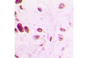 Immunohistochemical analysis of AP2 alpha/beta staining in human lung cancer formalin fixed paraffin embedded tissue section. (AP2 alpha/beta (C-Term) 抗体)