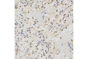 Immunohistochemistry of paraffin-embedded human kidney cancer using MSH2 antibody at dilution of 1:200 (x400 lens). (MSH2 抗体)