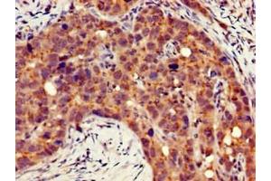 Immunohistochemistry of paraffin-embedded human pancreatic cancer using ABIN7156486 at dilution of 1:100 (Integrin beta 4 抗体  (AA 1401-1533))