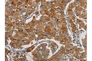 The image on the left is immunohistochemistry of paraffin-embedded Human breast cancer tissue using ABIN7190690(FOXF2 Antibody) at dilution 1/30, on the right is treated with synthetic peptide. (FOXF2 抗体)