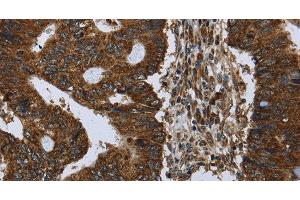 Immunohistochemistry of paraffin-embedded Human colon cancer using PPP1R13L Polyclonal Antibody at dilution of 1:30 (PPP1R13L 抗体)