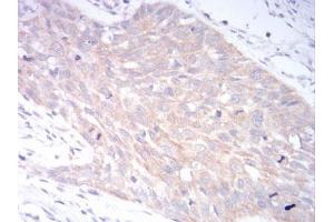 Immunohistochemical analysis of paraffin-embedded esophageal cancer tissues using LRP1 mouse mAb with DAB staining.
