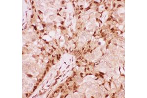 Anti-RUNX1/AML1 Picoband antibody ,  IHC(P): Human Mammary Cancer Tissue (RUNX1 抗体  (Middle Region))