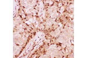 Anti-RUNX1/AML1 Picoband antibody ,  IHC(P): Human Mammary Cancer Tissue