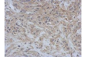 IHC-P Image Immunohistochemical analysis of paraffin-embedded U373 xenograft, using RAP1GDS1, antibody at 1:500 dilution. (RAP1GDS1 抗体  (N-Term))