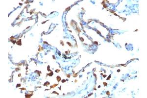 Formalin-fixed, paraffin-embedded human Lung Carcinoma stained with Milk Fat Globule Monoclonal Antibody (MFG-06) (MFGE8 抗体)