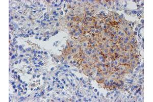 Immunohistochemical staining of paraffin-embedded Carcinoma of Human lung tissue using anti-RFXANK mouse monoclonal antibody. (RFXANK 抗体)