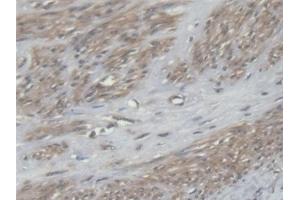 Detection of EEF2 in Human Uterine fibroids Tissue using Polyclonal Antibody to Eukaryotic Translation Elongation Factor 2 (EEF2)