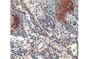 IHC-P analysis of skin cancer tissue, with DAB staining. (Follistatin 抗体  (AA 35-283))