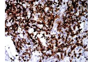 Immunohistochemical analysis of paraffin-embedded lung cancer tissues using CD2 mouse mAb with DAB staining. (CD2 抗体  (AA 25-140))