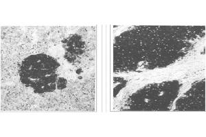 Left and Center: Immunohistochemical staining of normal pancreas tissue (left) and small bowel tumor tissue (center) using NSE antibody (X2070M and X2071M). (ENO2/NSE 抗体)