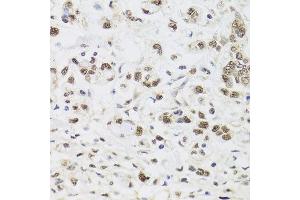 Immunohistochemistry of paraffin-embedded human gastric cancer using PPP1CC antibody at dilution of 1:100 (x40 lens). (PPP1CC 抗体)