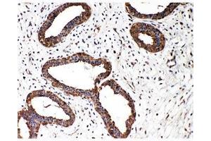 IHC-P: Smad2 antibody testing of human breast cancer tissue (SMAD2 抗体  (N-Term))
