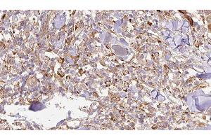 ABIN6276935 at 1/100 staining Human Melanoma tissue by IHC-P. (IL-24 抗体  (Internal Region))