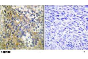 Immunohistochemistry analysis of paraffin-embedded human cervix carcinoma tissue using COL4A6 polyclonal antibody . (COL4a6 抗体)
