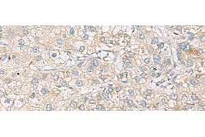 Immunohistochemistry of paraffin-embedded Human liver cancer tissue using RAC2 Polyclonal Antibody at dilution of 1:60(x200) (RAC2 抗体)