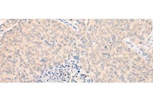 Immunohistochemistry of paraffin-embedded Human cervical cancer tissue using SEPT10 Polyclonal Antibody at dilution of 1:25(x200) (Septin 10 抗体)