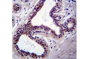 JNK1 antibody immunohistochemistry analysis in formalin fixed and paraffin embedded human breast tissue. (JNK 抗体  (AA 358-389))