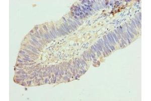 Immunohistochemistry of paraffin-embedded human ovarian cancer using ABIN7167036 at dilution of 1:100
