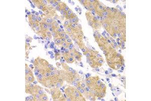 Immunohistochemistry of paraffin-embedded human gastric cancer using SMYD4 antibody. (SMYD4 抗体  (AA 1-260))