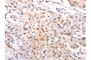 The image on the left is immunohistochemistry of paraffin-embedded Human breast cancer tissue using ABIN7191245(KRT6A/KRT6B/KRT6C/KRT6B/KRT6C Antibody) at dilution 1/40, on the right is treated with synthetic peptide. (KRT6A/KRT6B/KRT6C 抗体)