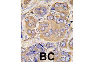 Formalin-fixed and paraffin-embedded human breast carcinoma tissue reacted with HSPB1 polyclonal antibody  , which was peroxidase-conjugated to the secondary antibody, followed by DAB staining. (HSP27 抗体  (Ser78))