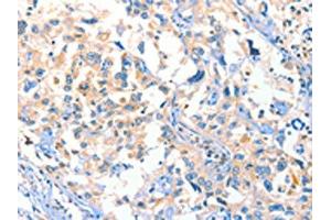 The image on the left is immunohistochemistry of paraffin-embedded Human esophagus cancer tissue using ABIN7129275(DUSP14 Antibody) at dilution 1/20, on the right is treated with fusion protein. (DUSP14 抗体)