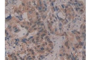 Detection of CIRBP in Human Breast cancer Tissue using Polyclonal Antibody to Cold Inducible RNA Binding Protein (CIRBP)