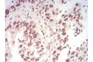 Immunohistochemical analysis of paraffin-embedded endometrial cancer tissues using WTAP mouse mAb with DAB staining. (WTAP 抗体  (AA 91-201))