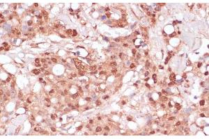 Immunohistochemistry of paraffin-embedded Human breast cancer using BYSL Polyclonal Antibody at dilution of 1:100 (40x lens). (Bystin-Like 抗体)
