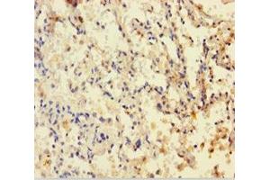 Immunohistochemistry of paraffin-embedded human lung cancer using ABIN7149900 at dilution of 1:100 (Dihydrofolate Reductase 抗体  (AA 2-187))