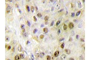 Immunohistochemistry analyzes of RORα antibody in paraffin-embedded human breast carcinoma tissue.
