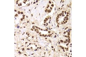 Immunohistochemistry of paraffin-embedded human breast cancer using ANP32A Antibody. (PHAP1 抗体)