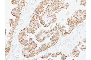 IHC-P Image Immunohistochemical analysis of paraffin-embedded human ovarian cancer, using Adenylate cyclase 2, antibody at 1:250 dilution. (ADCY2 抗体)