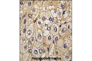Formalin-fixed and paraffin-embedded human hepatocarcinoma tissue reacted with EphA7 antibody , which was peroxidase-conjugated to the secondary antibody, followed by DAB staining. (EPH Receptor A7 抗体)