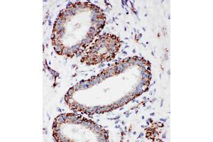Anti-MTCO1 antibody, IHC(P): Human Mammary Cancer Tissue (COX1 抗体  (C-Term))