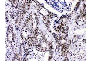 IHC testing of FFPE human intestinal cancer with hnRNP F antibody at 1ug/ml. (HNRNPF 抗体  (AA 23-53))