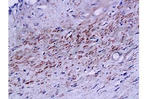 Formalin-fixed and paraffin embedded human prostate labeled with Rabbit Anti phospho-Androgen Receptor(Ser578) Polyclonal Antibody, Unconjugated (ABIN730123) at 1:200 followed by conjugation to the secondary antibody and DAB staining (Androgen Receptor 抗体  (pSer578))