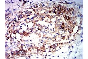 Immunohistochemical analysis of paraffin-embedded stomach cancer tissues using MUC2 mouse mAb with DAB staining. (MUC2 抗体  (AA 4373-4557))