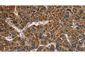 Immunohistochemistry of paraffin-embedded Human liver cancer using CAT Polyclonal Antibody at dilution of 1:40 (Catalase 抗体)
