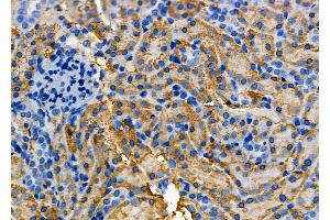 ABIN6260984 and ABIN6278821 at 1/100 staining Human ovarian cancer by IHC-P.