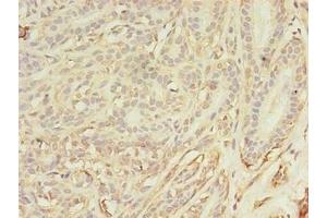 Immunohistochemistry of paraffin-embedded human breast cancer using ABIN7144179 at dilution of 1:100 (ASB11 抗体  (AA 41-315))