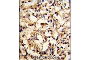 Formalin-fixed and paraffin-embedded human breast carcinoma reacted with DFNA5 Antibody (N-term), which was peroxidase-conjugated to the secondary antibody, followed by DAB staining. (DFNA5 抗体  (N-Term))