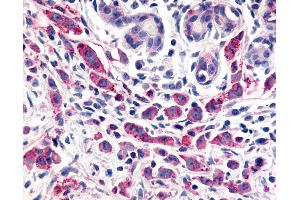 Anti-ELTD1 antibody IHC of human Breast, Carcinoma. (ELTD1 抗体  (N-Term))