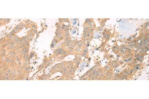 Immunohistochemistry of paraffin-embedded Human colorectal cancer tissue using ASIC3 Polyclonal Antibody at dilution of 1:40(x200) (ASIC3 抗体)