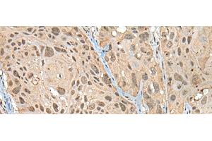 Immunohistochemistry of paraffin-embedded Human esophagus cancer tissue using ZNF468 Polyclonal Antibody at dilution of 1:30(x200)