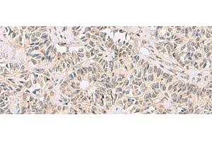 Immunohistochemistry of paraffin-embedded Human ovarian cancer tissue using RNF13 Polyclonal Antibody at dilution of 1:60(x200) (RNF13 抗体)